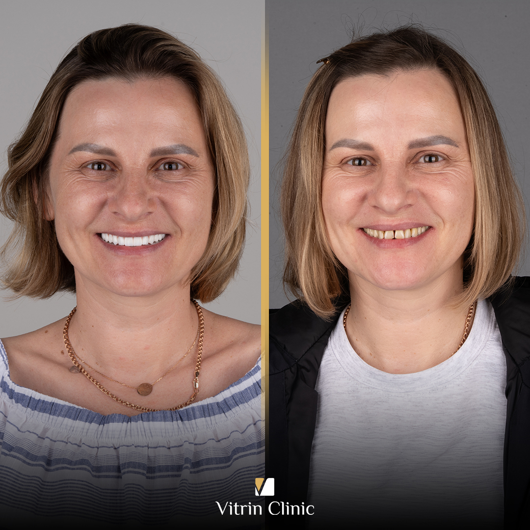 What Are the Benefits, Costs, and Results of Emax Crowns, and How Do They Compare With Zirconia?